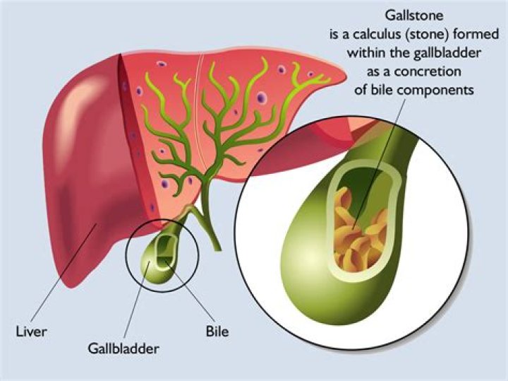 How fast do gallstones grow?