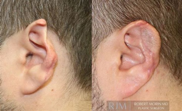 How is incisionless otoplasty done?