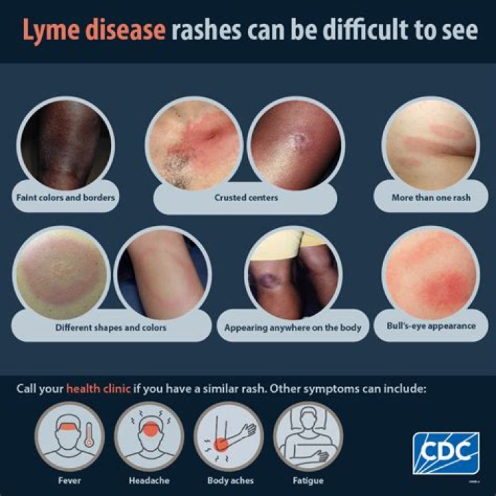 How long after a tick bite do you get Lyme disease?