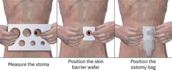 How long are you in hospital after a stoma operation?