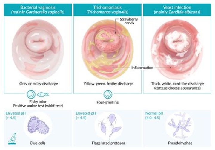 How long can you carry trichomoniasis without knowing?