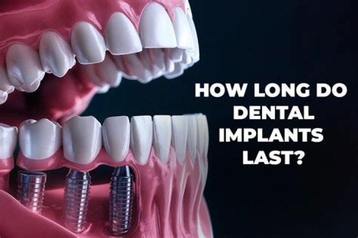 How long do brain implants last?