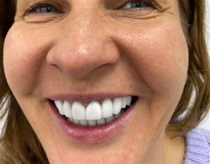 How long do Turkey teeth last?