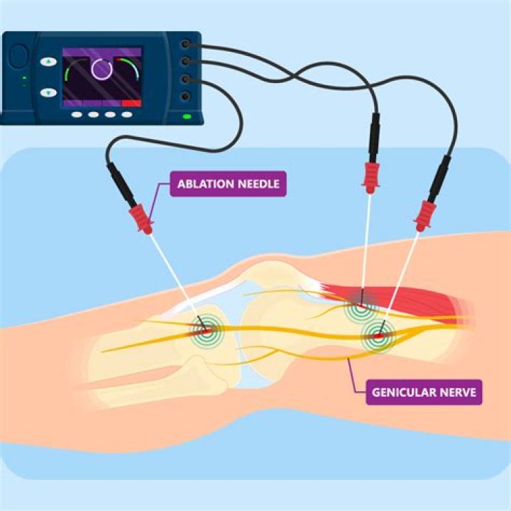 How long does ablation surgery take?