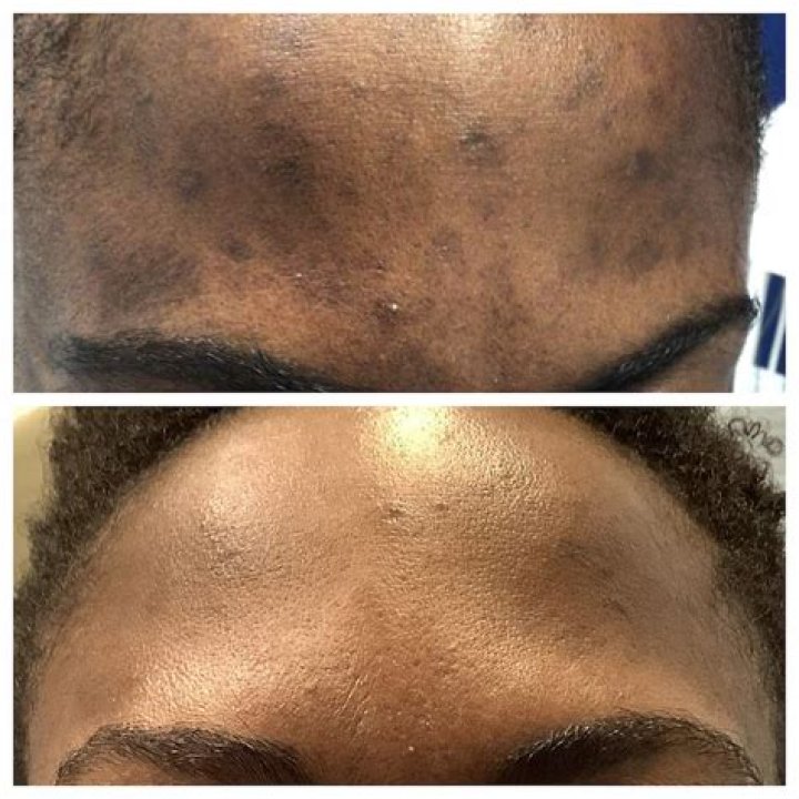 How long does it take for pigmentation to fade?