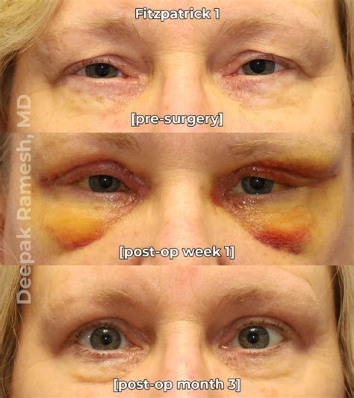 How long does it take to recover from laser cataract surgery?