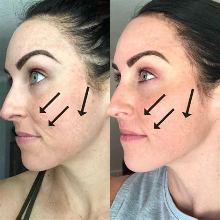 How long does it take to see results from micro needling?