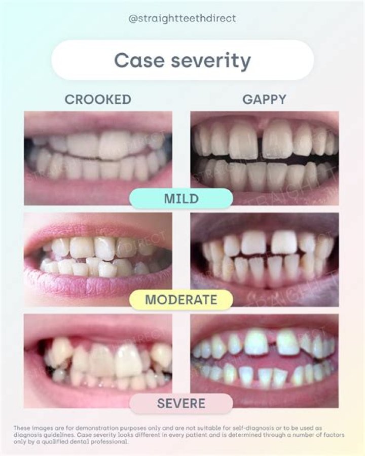 How long will braces take?
