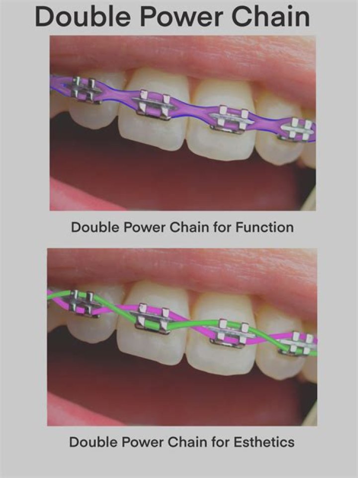 How much do power chain braces cost?