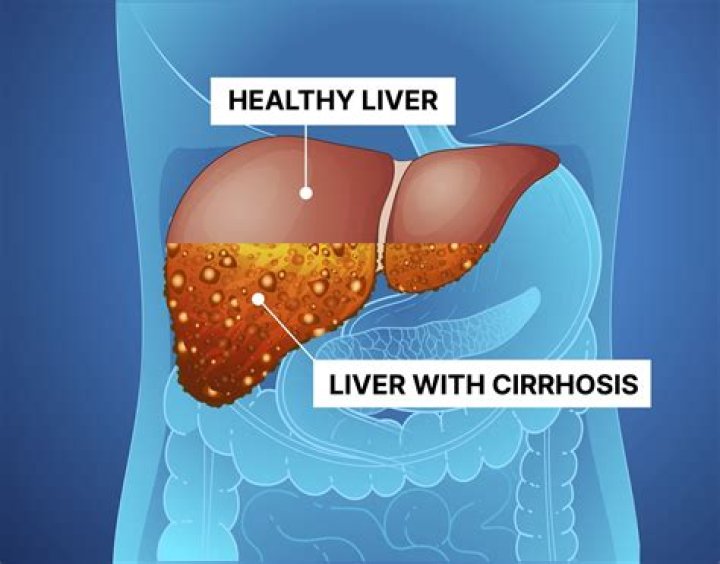 How much does a woman have to drink to get cirrhosis?