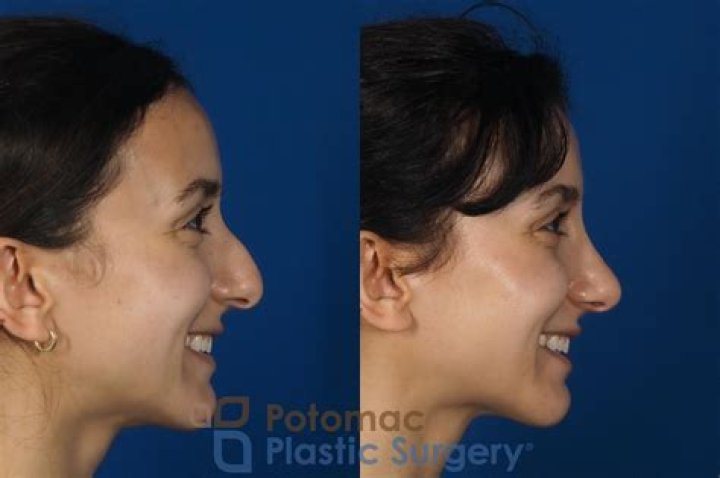 How much is a rhinoplasty with Paul Nassif?