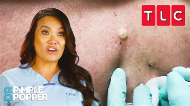 How much it costs to see Dr. Pimple Popper?