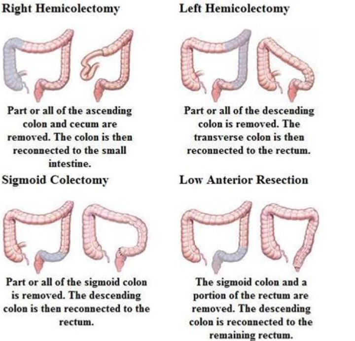 How much of your colon can be removed?