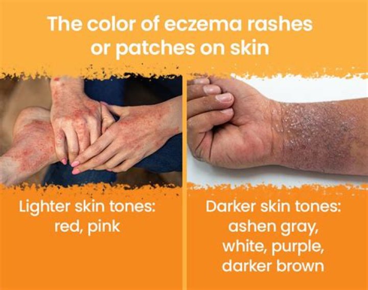 How much water clears up eczema?