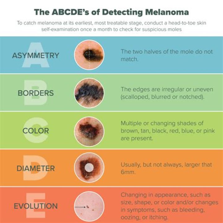 How often do dermatologists miss melanoma?