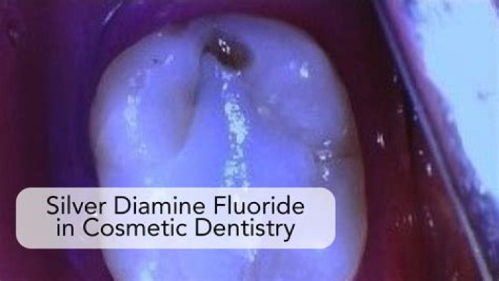 How often should silver diamine fluoride be applied?