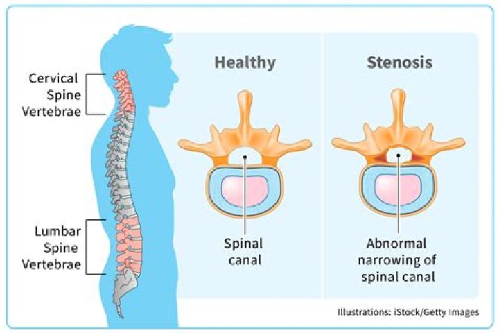 How rare is a spinal Tumour?