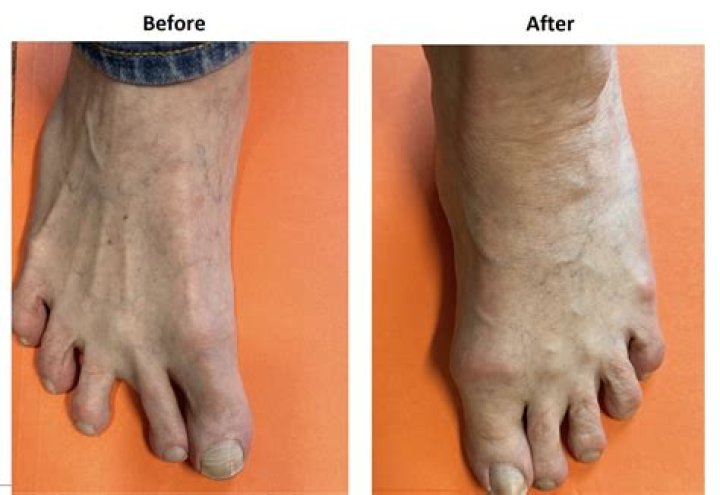 How soon can you put weight on your foot after bunion surgery?