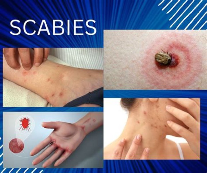 How will I know when my scabies are gone?