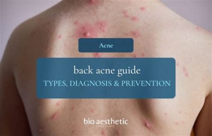 Is back acne embarrassing?