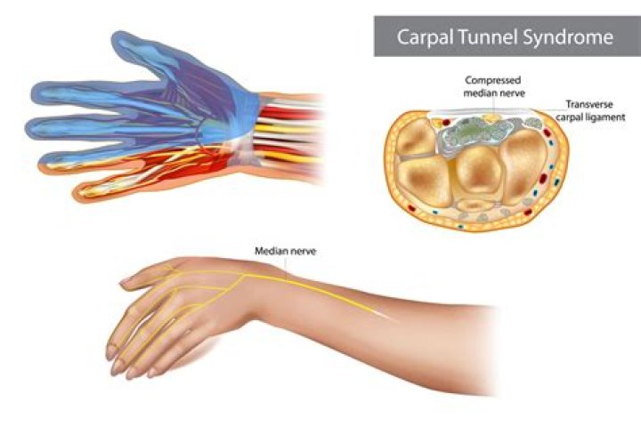 Is carpal tunnel on the disability list?