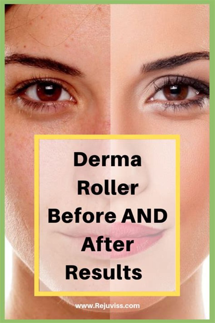 Is Derma Roller really effective?