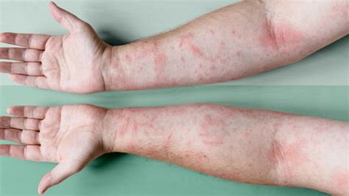 Is eczema gut related?