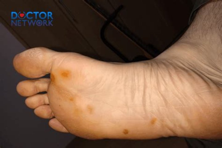 Is freckle on bottom of foot normal?