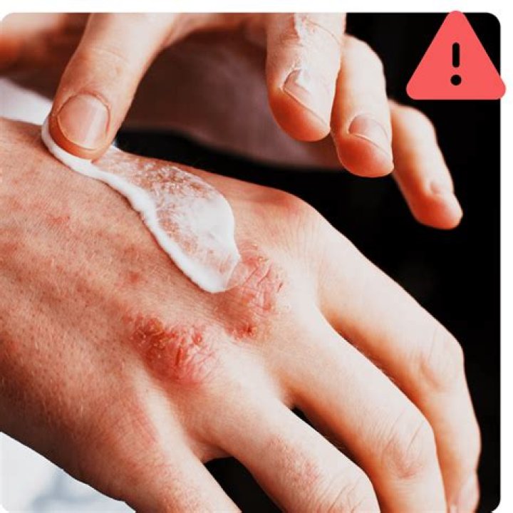 Is ice good for eczema?