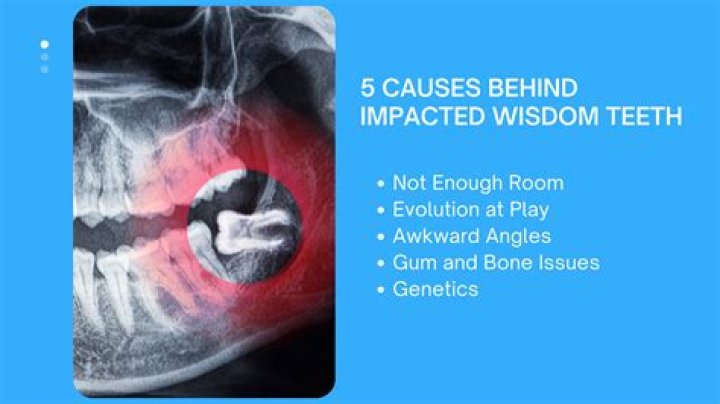 Is it better to leave wisdom teeth in?