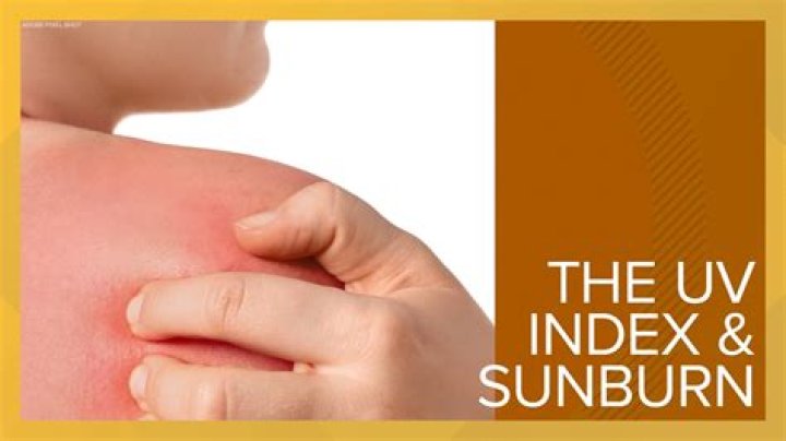 Is it better to sleep without a shirt when sunburned?