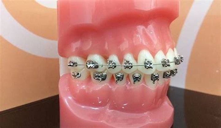 Is it normal for my back teeth to not touch with braces?