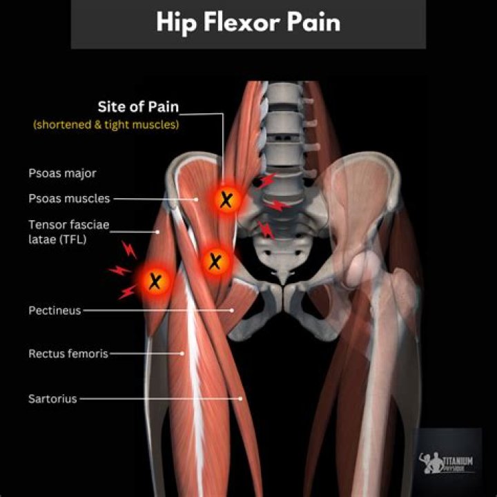 Is it OK to run with hip flexor pain?