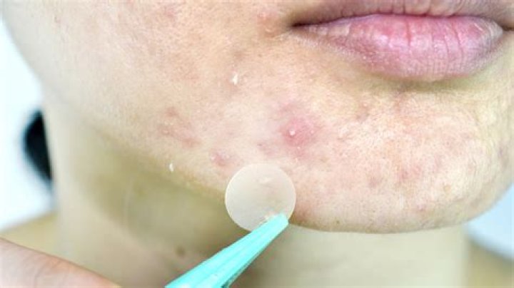 Is it okay to pluck whiteheads?