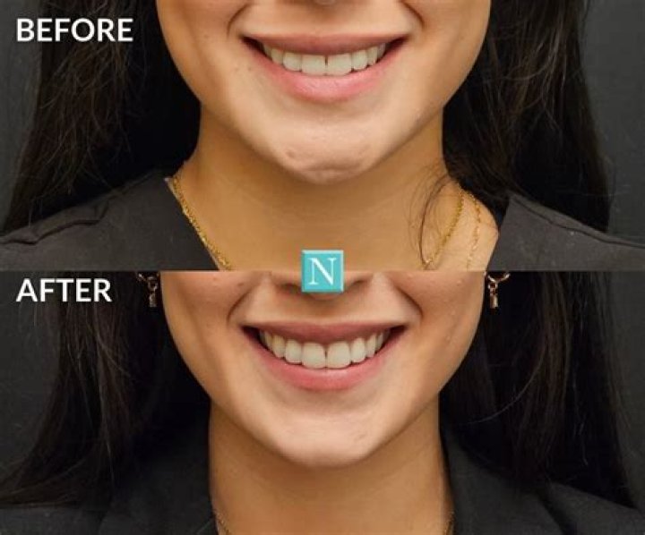 Is it possible to have a dimple on your tongue?