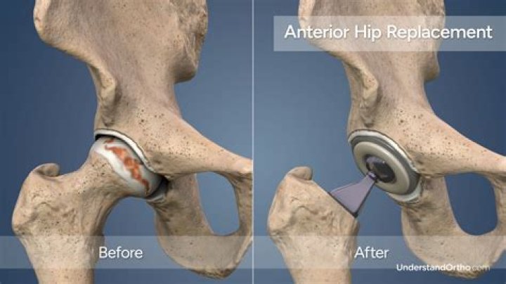 Is limp common after hip replacement?