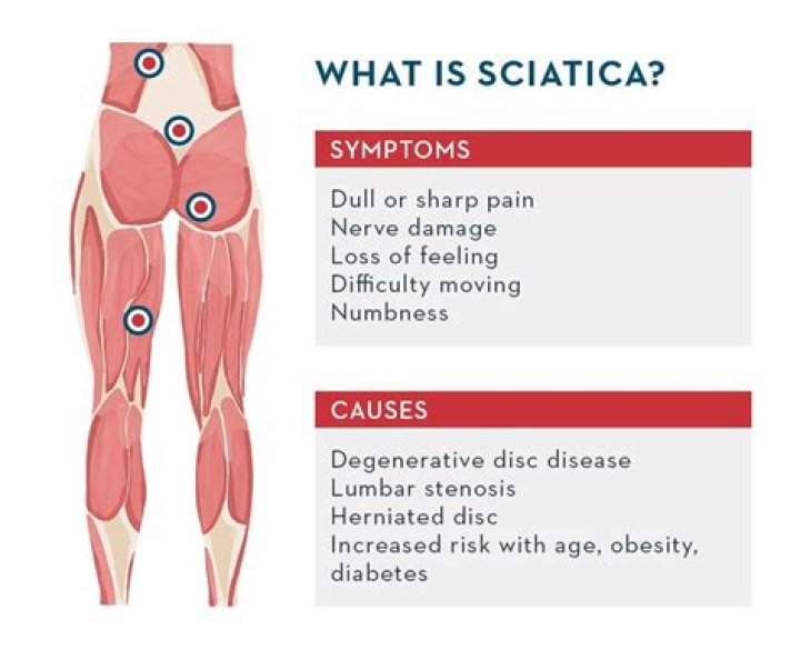 Is Sciatica a symptom of fibromyalgia?