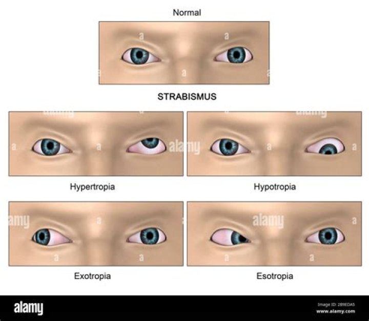 Is strabismus neurological?