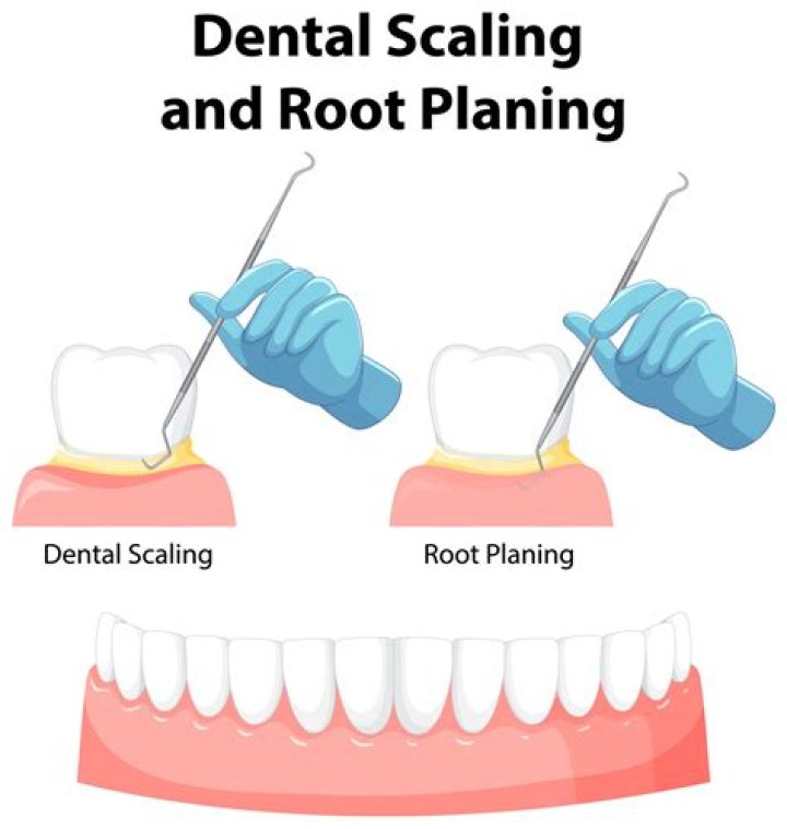 Is teeth scaling painful?