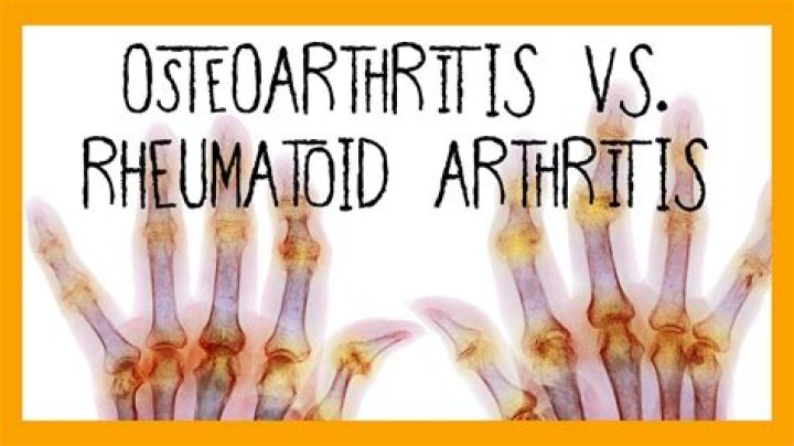 Is there a difference between rheumatoid arthritis and inflammatory arthritis?