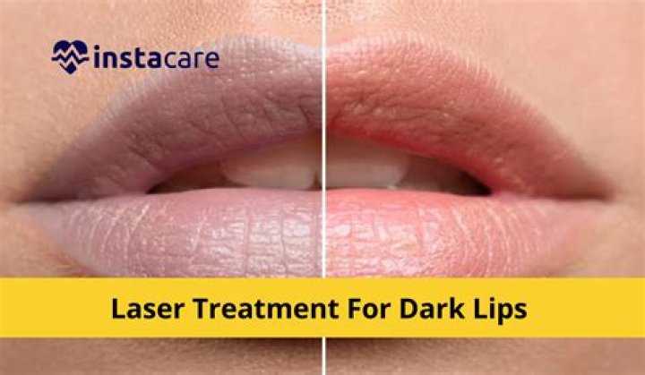 Is there any laser treatment for dark lips?