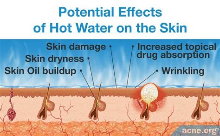 Is warm water good for acne?