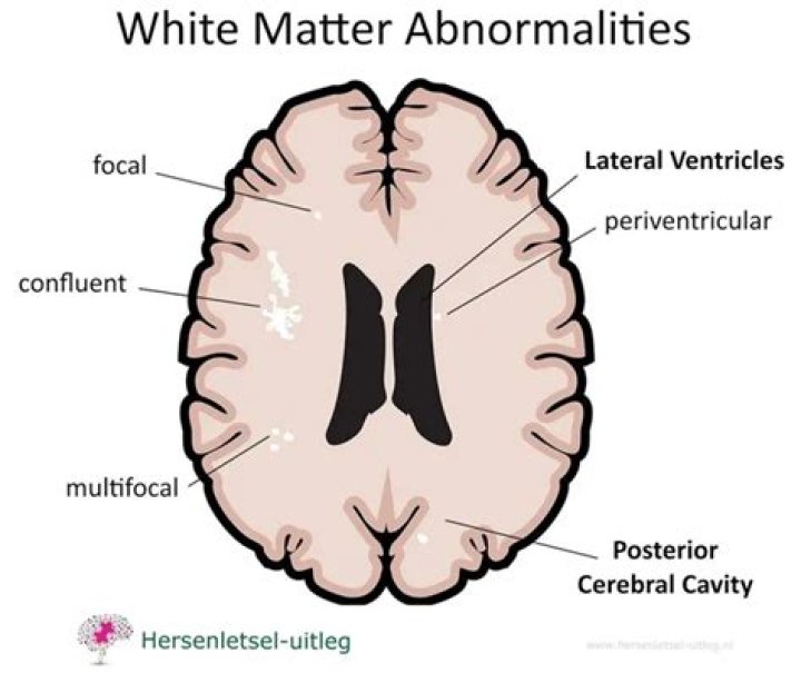 Is white matter disease dementia?