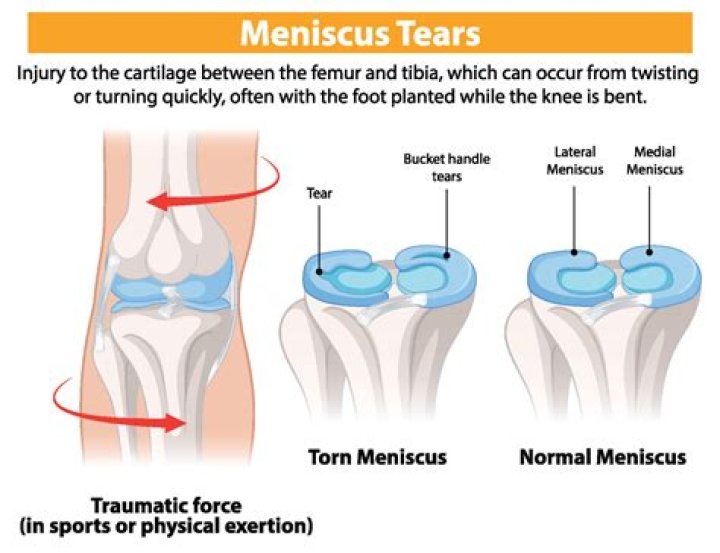Should I be on Crutches with a torn meniscus?