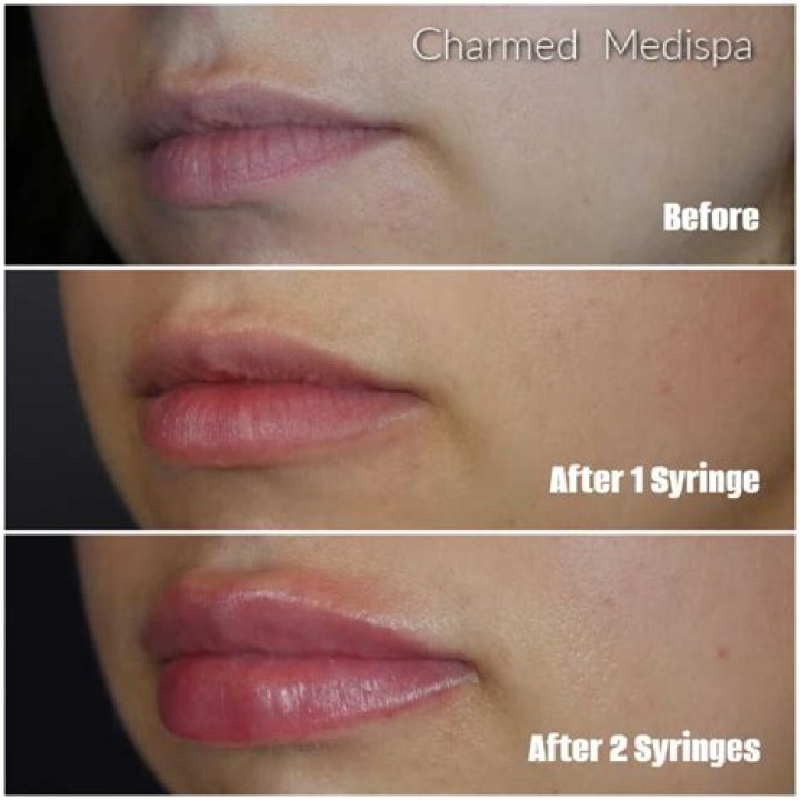 Should I get 1ml or 2ml lip filler?