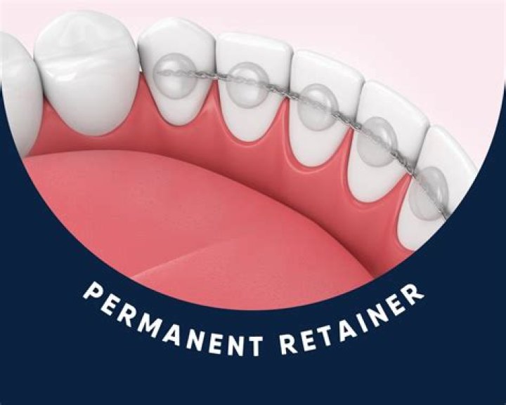 Should I store retainer in water?