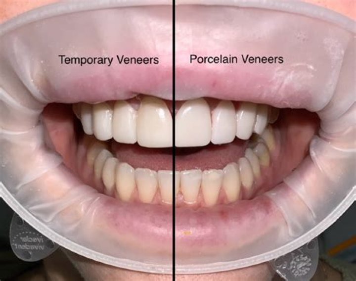 Should veneers be replaced over time?