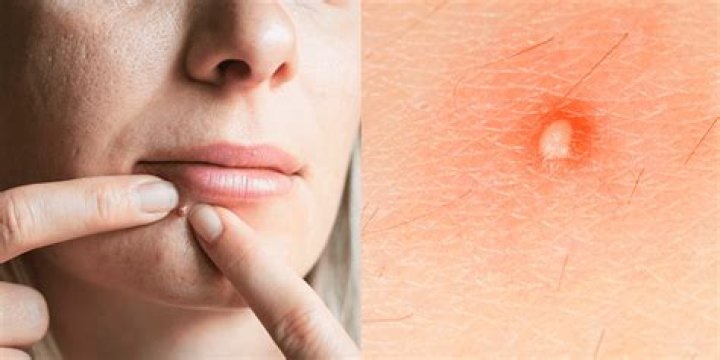 Should you pop pimples when they are white?