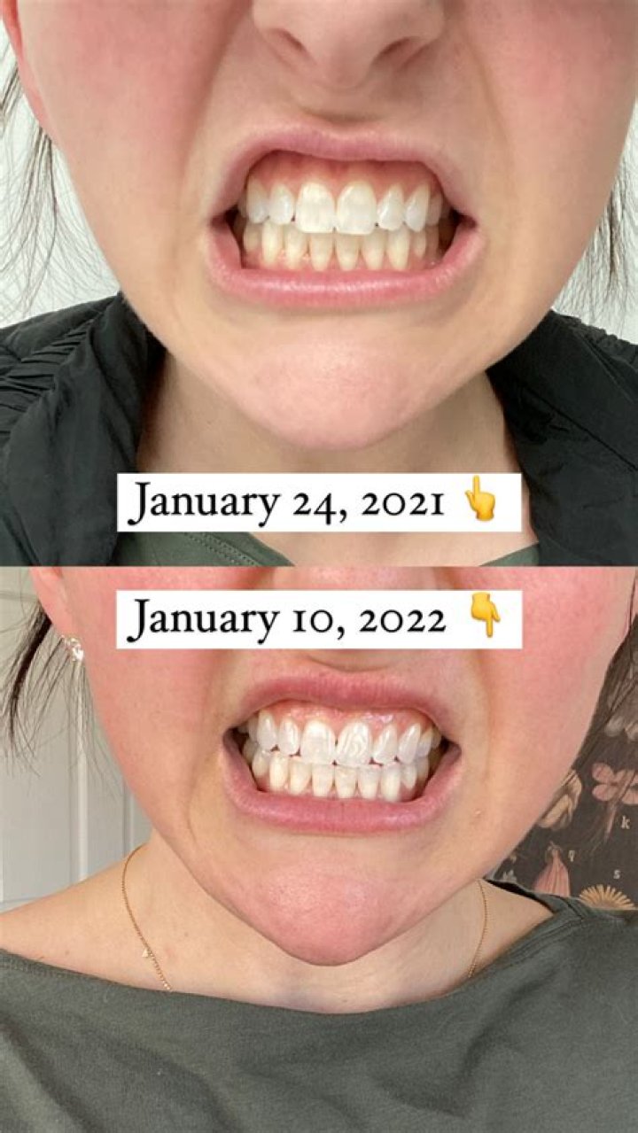What's the secret to White teeth?