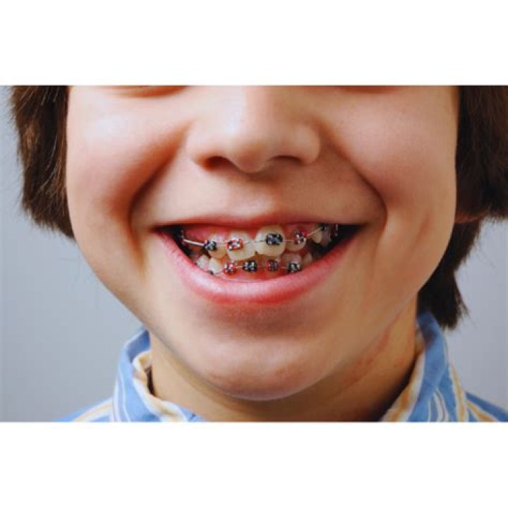 What's the youngest age to get braces?